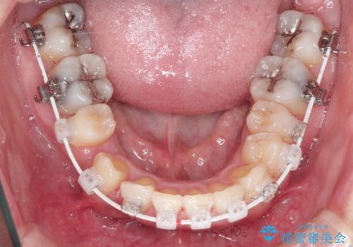 犬歯が変な位置にある 抜歯矯正により正しい位置への治療中