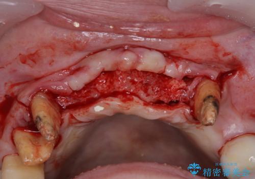出血が止まらない インプラント補綴を用いた歯周病治療の治療前