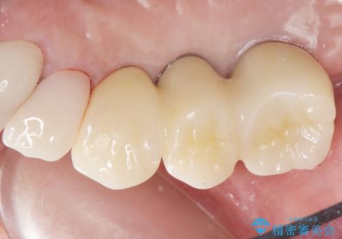 歯がぐらぐら 上顎洞底挙上術を併用した奥歯のインプラント 50代男性の治療後