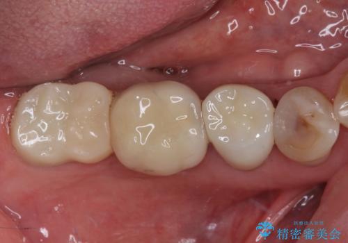 かけて金属の見えてしまったセラミック 強化セラミックでの補綴治療の治療後