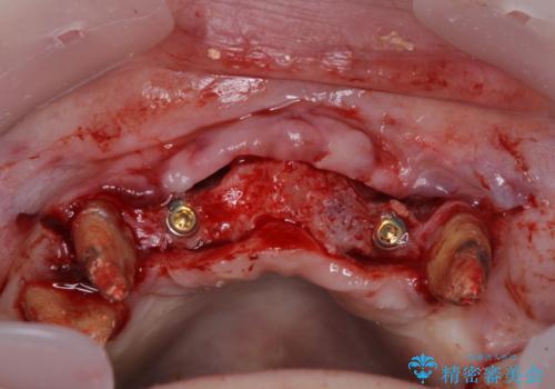 出血が止まらない インプラント補綴を用いた歯周病治療の治療中