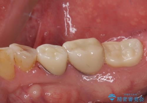 かけて金属の見えてしまったセラミック 強化セラミックでの補綴治療の治療後