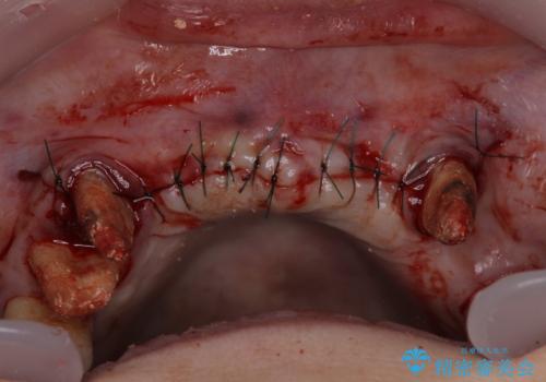 出血が止まらない インプラント補綴を用いた歯周病治療の治療後