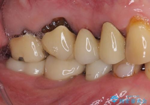 かけて金属の見えてしまったセラミック 強化セラミックでの補綴治療の治療後