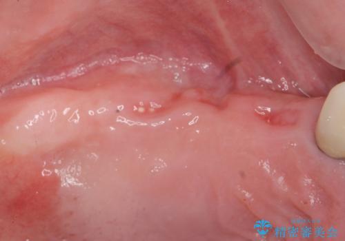 歯がぐらぐら 上顎洞底挙上術を併用した奥歯のインプラント 50代男性の治療中