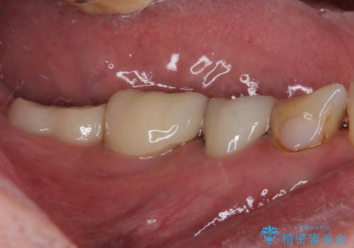 かけて金属の見えてしまったセラミック 強化セラミックでの補綴治療の治療後