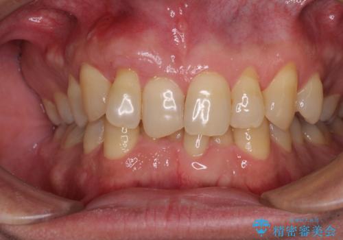 歯根が露出している歯の歯肉移植 根面被覆術の治療後