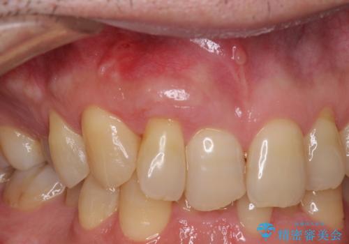 歯根が露出している歯の歯肉移植　根面被覆術の治療後