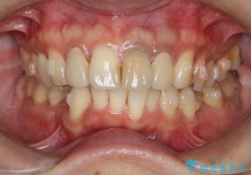 歯並びを含めて前歯をきれいにしたい インビザラインとセラミック治療の治療中