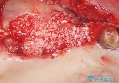 歯がぐらぐら 上顎洞底挙上術を併用した奥歯のインプラント 50代男性の治療中