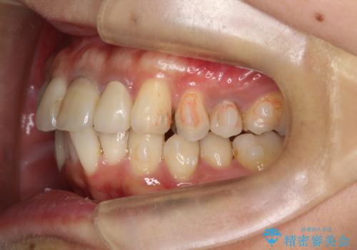 歯並びを含めて前歯をきれいにしたい インビザラインとセラミック治療の治療中