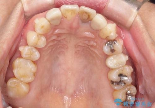 歯並びを含めて前歯をきれいにしたい インビザラインとセラミック治療の治療中