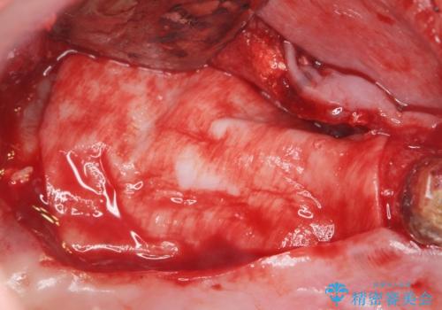 歯がぐらぐら 上顎洞底挙上術を併用した奥歯のインプラント 50代男性の治療中