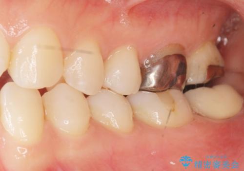 歯が割れた 親知らずの移植 30代女性の治療後