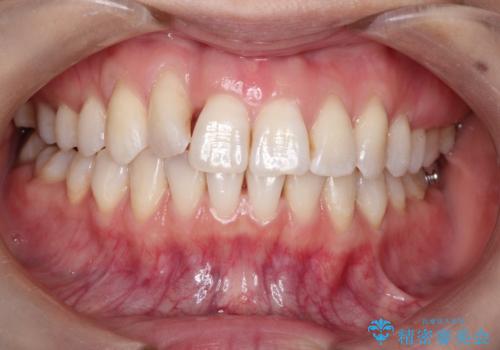 インビザラインによる矯正治療 前歯を整った歯並びへの治療中