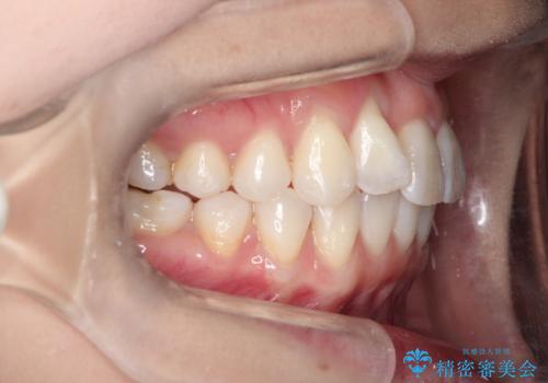 インビザラインによる矯正治療 前歯を整った歯並びへの治療中