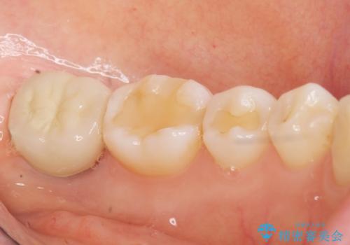 歯が割れた 親知らずの移植 30代女性の治療後