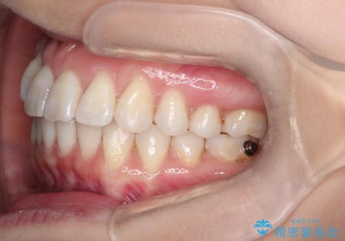 インビザラインによる矯正治療　前歯を整った歯並びへの治療中