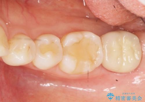 歯が割れた 親知らずの移植 30代女性の治療後