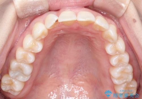 インビザラインによる矯正治療 前歯を整った歯並びへの治療中