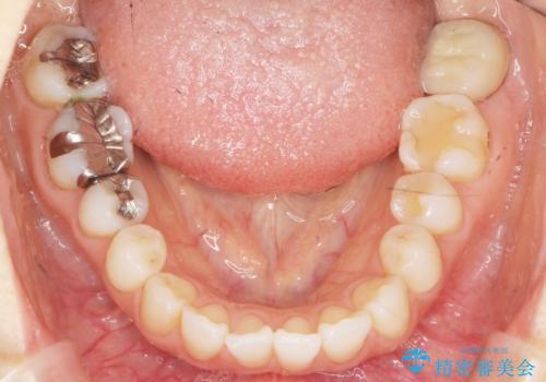 歯が割れた 親知らずの移植 30代女性の治療後