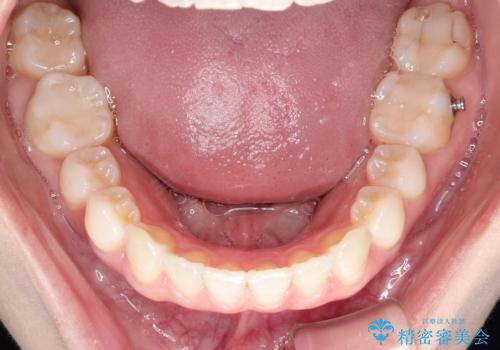 インビザラインによる矯正治療　前歯を整った歯並びへの治療中
