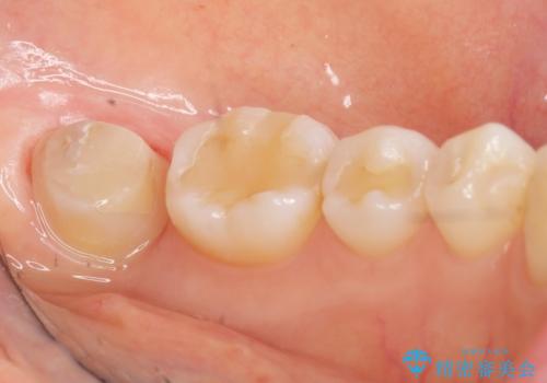 歯が割れた 親知らずの移植 30代女性の治療後