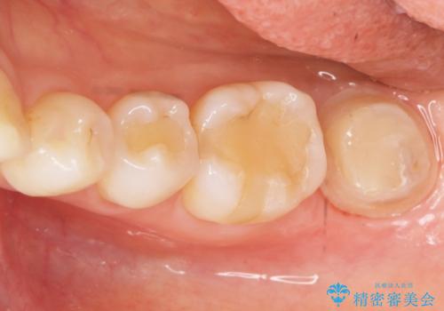 歯が割れた 親知らずの移植 30代女性の治療後