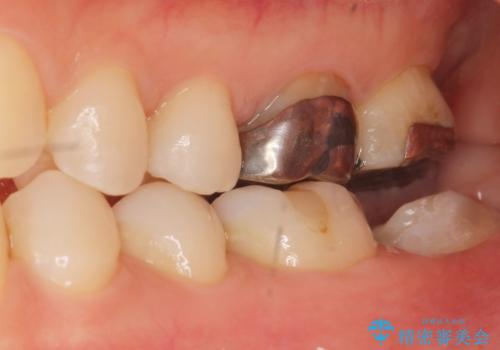 歯が割れた 親知らずの移植 30代女性の治療中