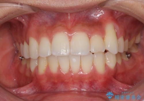 八重歯と奥歯のクロスバイト 上顎骨を拡大してインビザラインで矯正の治療中
