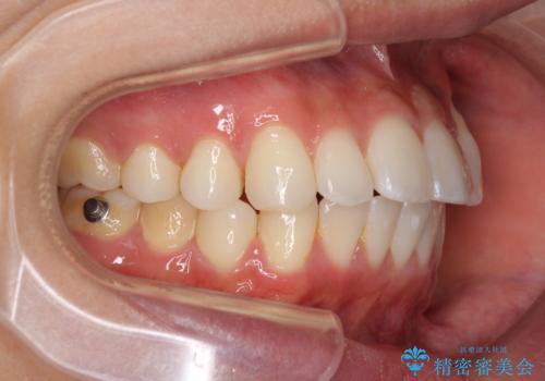 八重歯と奥歯のクロスバイト 上顎骨を拡大してインビザラインで矯正の治療中