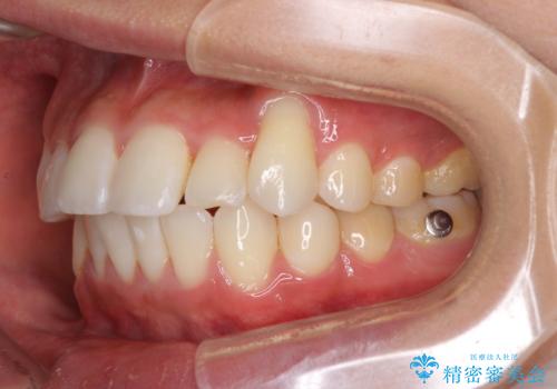 八重歯と奥歯のクロスバイト　上顎骨を拡大してインビザラインで矯正の治療中