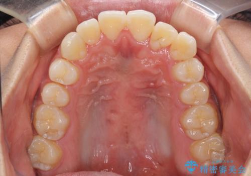 八重歯と奥歯のクロスバイト 上顎骨を拡大してインビザラインで矯正の治療中