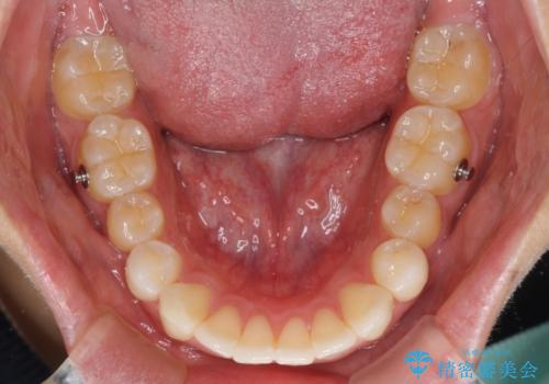 八重歯と奥歯のクロスバイト　上顎骨を拡大してインビザラインで矯正の治療中