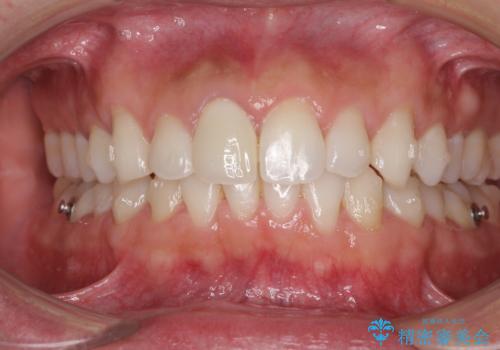 口が閉じにくい インビザラインによる矯正治療の治療中