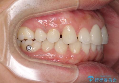 口が閉じにくい インビザラインによる矯正治療の治療中