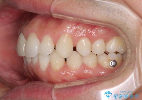 口が閉じにくい インビザラインによる矯正治療の治療中
