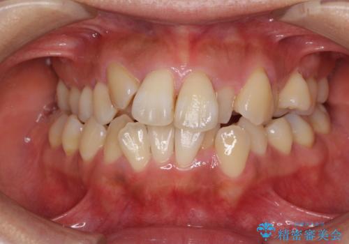 狭い上顎骨を拡大 著しい叢生を抜歯矯正で改善の治療前