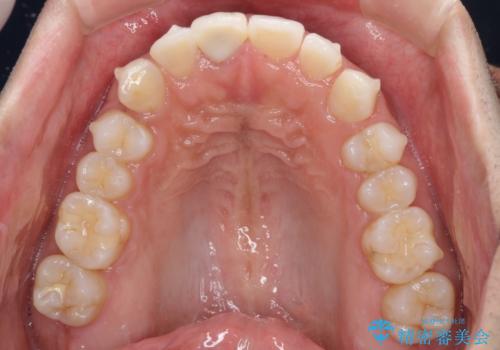 口が閉じにくい インビザラインによる矯正治療の治療中