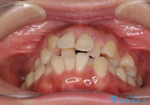 狭い上顎骨を拡大 著しい叢生を抜歯矯正で改善の治療前