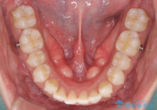 口が閉じにくい インビザラインによる矯正治療の治療中