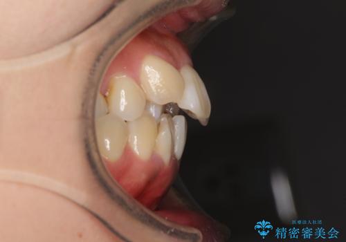 狭い上顎骨を拡大　著しい叢生を抜歯矯正で改善の治療前