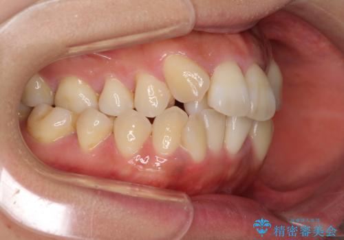 狭い上顎骨を拡大 著しい叢生を抜歯矯正で改善の治療前