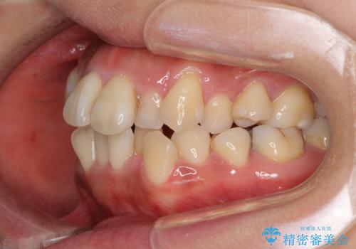 狭い上顎骨を拡大 著しい叢生を抜歯矯正で改善の治療前