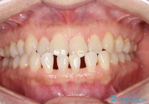 前歯の隙間　インビザラインによる目立たない成人矯正の症例 治療前