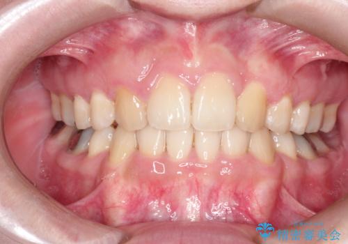 犬歯が変な位置にある　抜歯矯正により正しい位置への症例 治療後