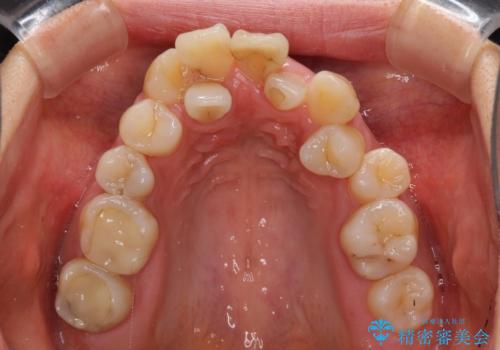 狭い上顎骨を拡大 著しい叢生を抜歯矯正で改善の治療前