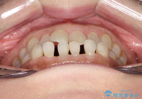 前歯の隙間 インビザラインによる目立たない成人矯正の治療前