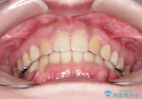 犬歯が変な位置にある 抜歯矯正により正しい位置への治療後