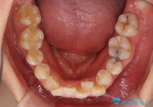 狭い上顎骨を拡大 著しい叢生を抜歯矯正で改善の治療前